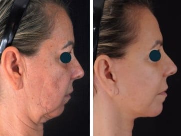 Lifting de cuello caso 1 — antes y después